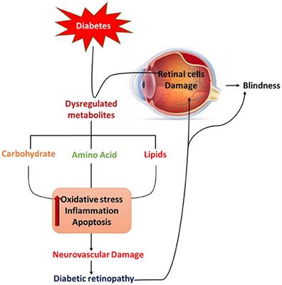 Implications of Diabetes-Induced Altered Metabolites on Retinal Neurodegeneration